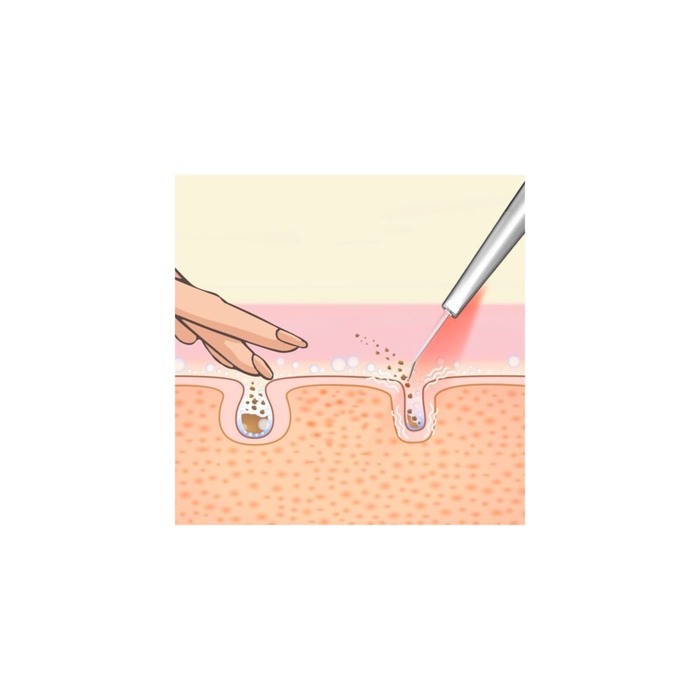 Lumineo LED kavitacinis šveitiklis + drėkinamasis tonikas5